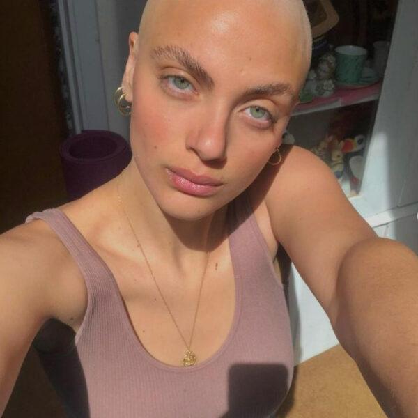 BALD IS BEAUTIFUL: Model Shaves Head After Battle With Alopecia