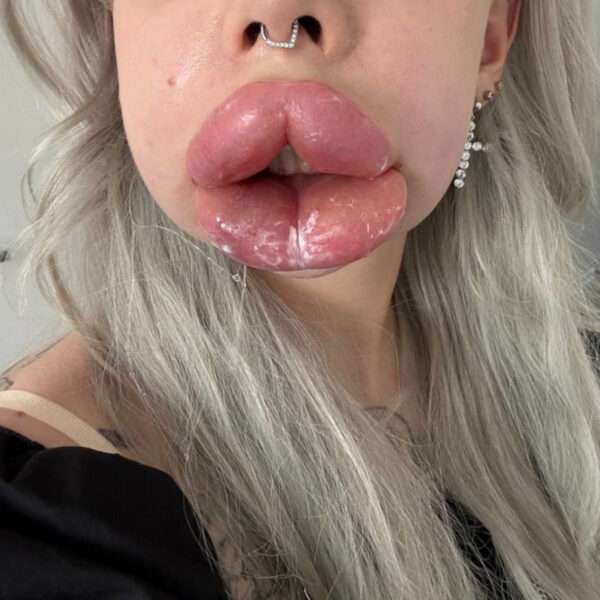  Influencer’s Lips Swelled Up To Bursting Point After Allergic Reaction